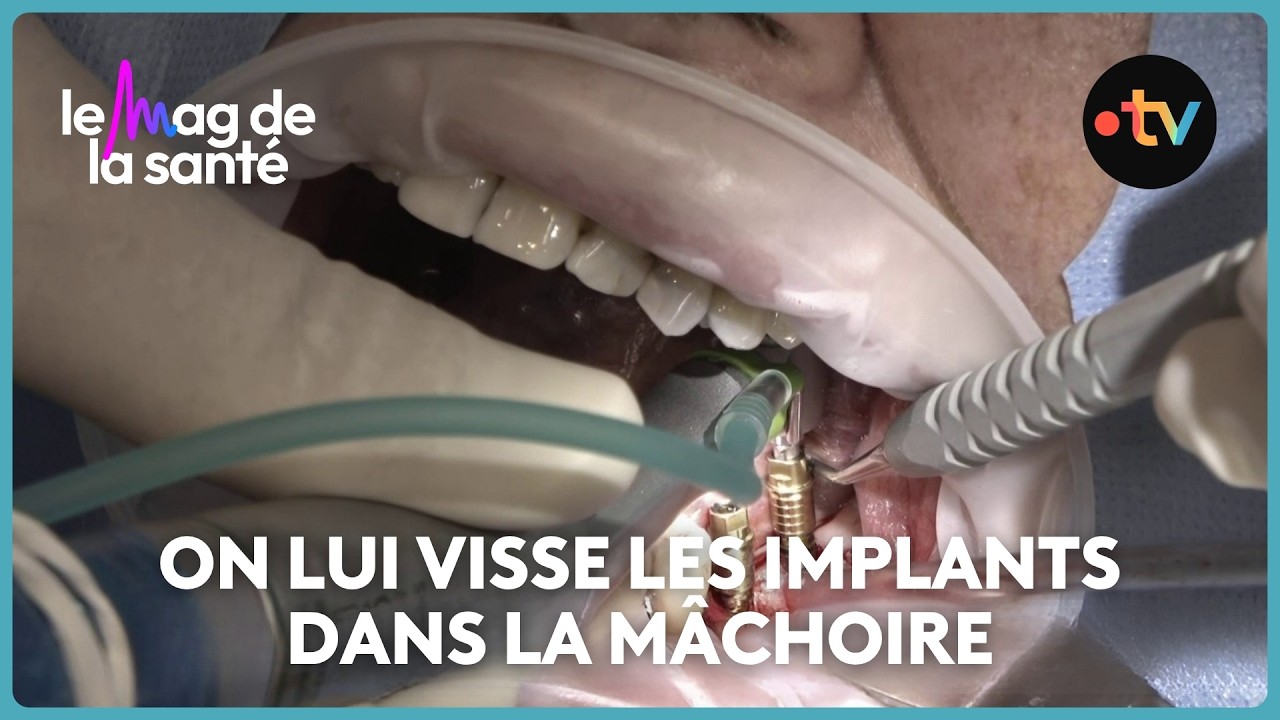 Tout savoir sur la chirurgie de la pose de prothèses dentaires